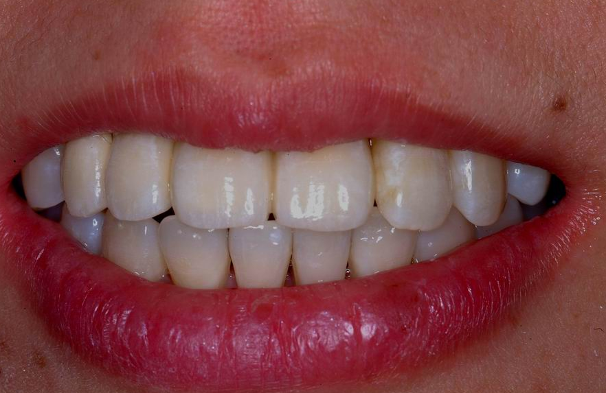 Advanced Implant Bridge